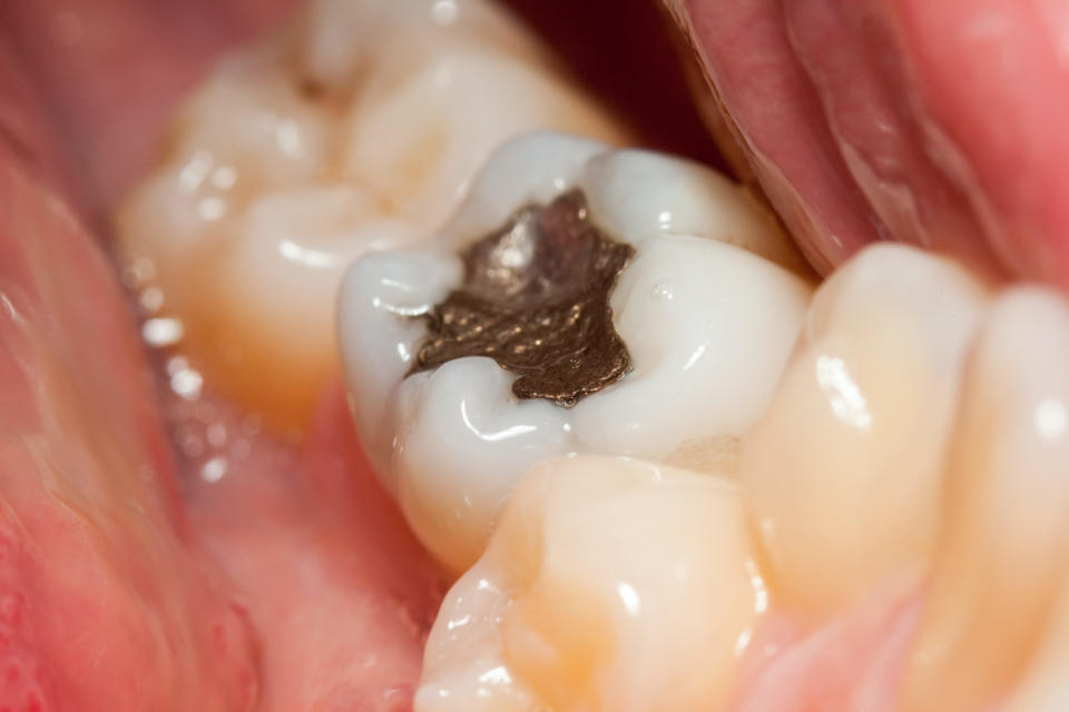 Ein Zahn mit Amalgam-Füllung. - Copyright: icefront / iStock / Getty Images Plus I 