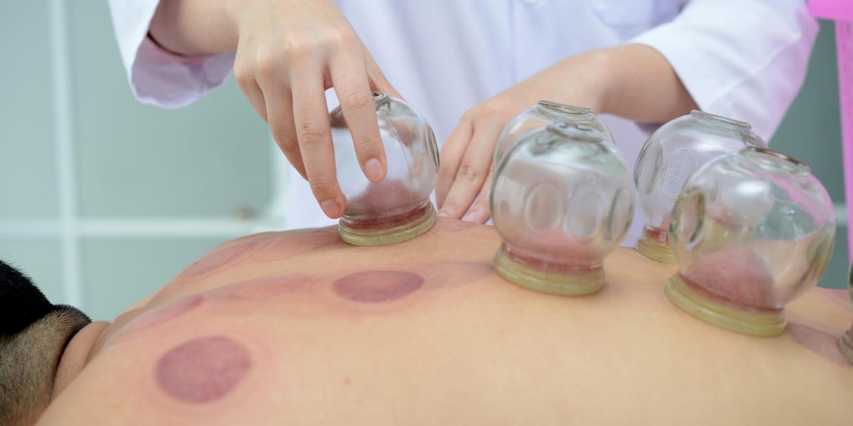 cupping therapy cupping marks alternative medicine