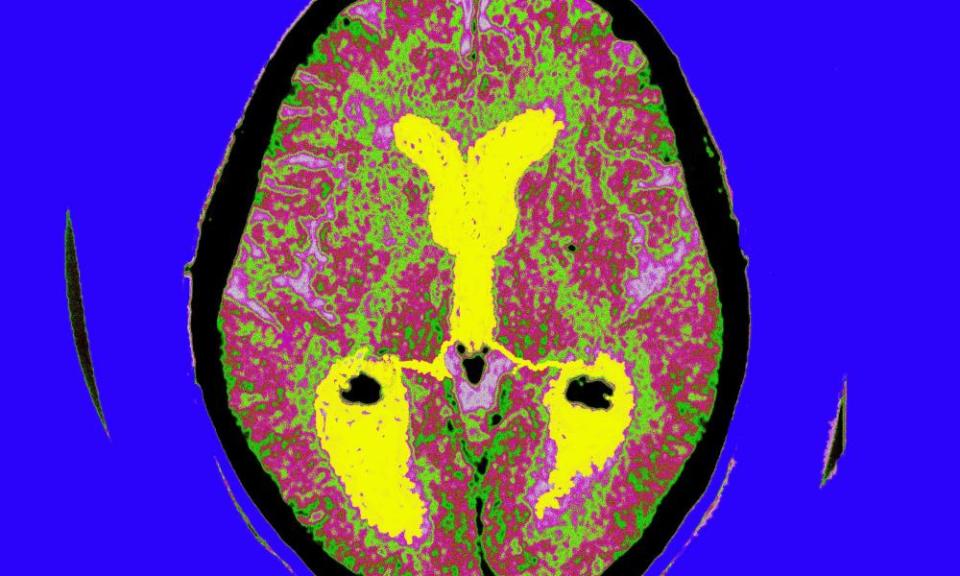 Brain scan of a patient with Alzheimer’s disease.