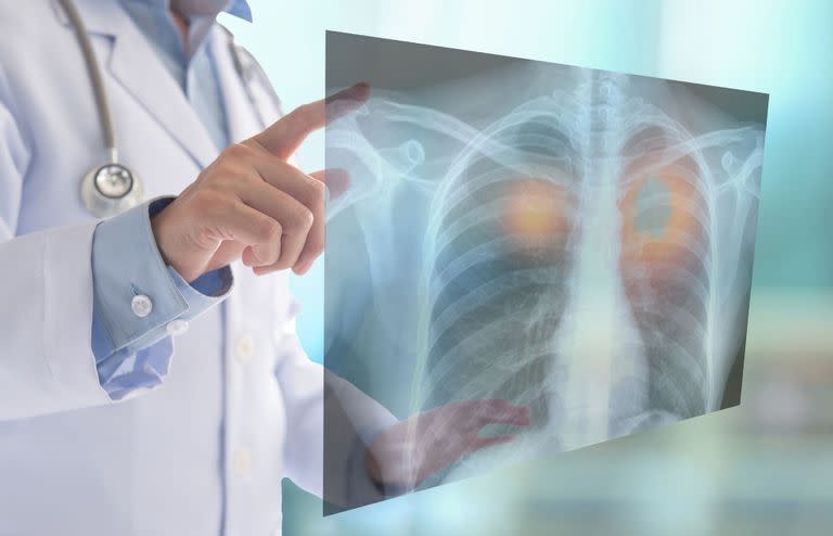 Según las cifras oficiales, a nivel local el cáncer de “tráquea, de los bronquios y del pulmón” es el que más vidas de lleva, seguido por el cáncer de colon