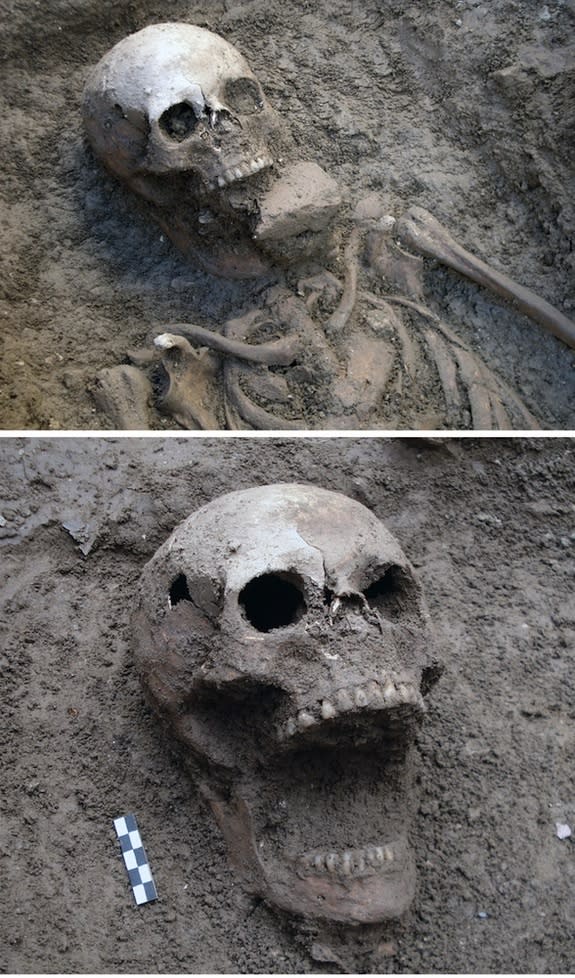 A skeleton buried in the cemetery of Vecchiano in Pisa showing a similar condition to the purported "Venetian vampire."