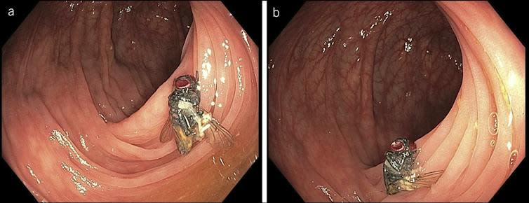 Image of a dead fly inside a man's colon.