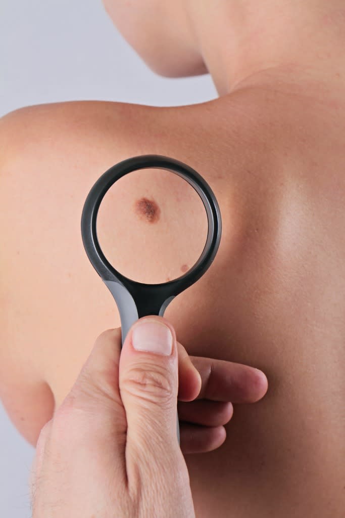 Early detection is to thank for the decreased rates of melanoma, especially in New England. (Photo: Getty)