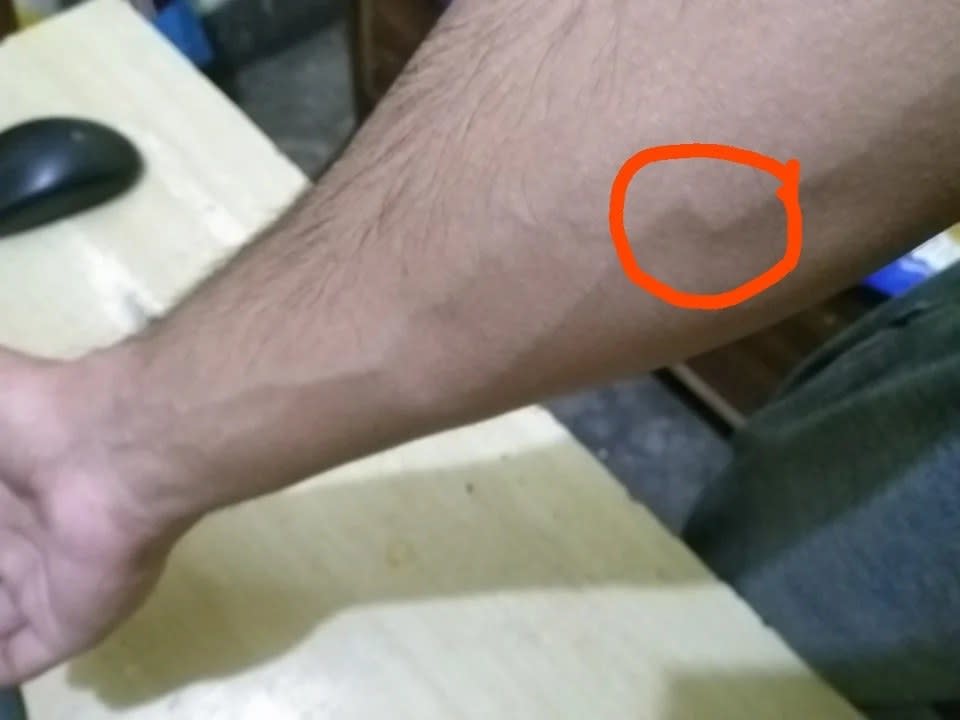 A man's arm with a circle around part of his arm vein that is at a 90 degree angle