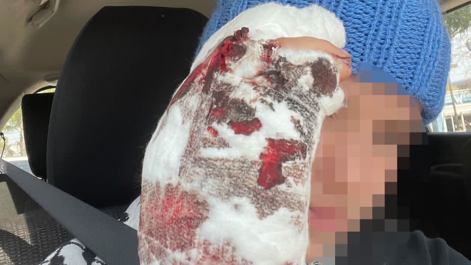 Thistle Boosinger, a 23-year-old member of the encampment, had her hand smashed the night of the violence. Boosinger requested CNN obscure a portion of this image over privacy concerns following recent developments. - Courtesy Thistle Boosinger