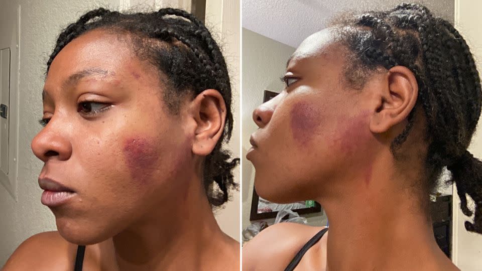 Photos of Christina Pierre taken one day after an encounter with police. - Attorney Lauren Newton