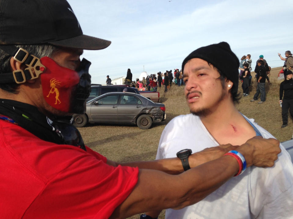 <p>A Dakota Access oil pipeline protester shows where he was hit by a shotgun bean bag round fired by officers trying to force protesters from a camp on private land in the path of pipeline construction, Thursday, Oct. 27, 2016. near Cannon Ball, N.D. (Photo: James MacPherson/AP) </p>