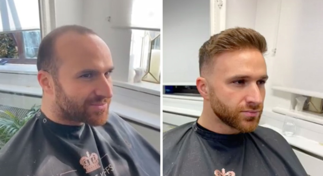 A before and after hair loss image of a man getting a hair system fitted. (Caters)