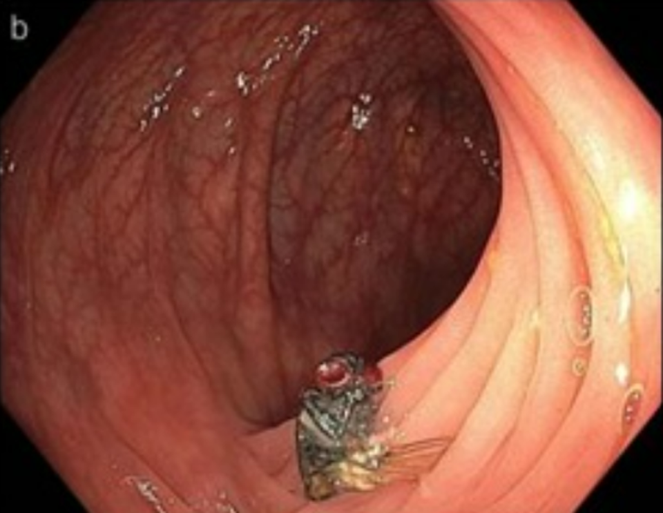 The fly was prodded but did not move (American Journal of Gastroenterology)