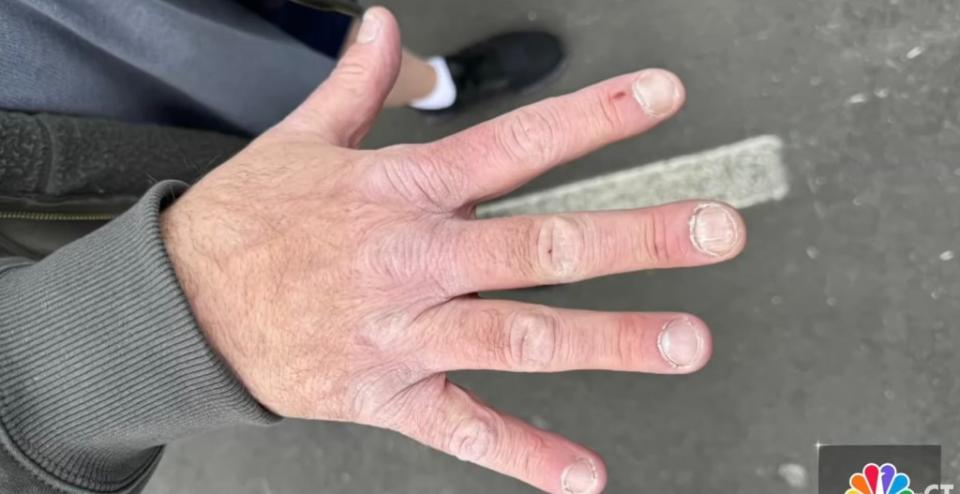 Ganter’s hand also had a mark on it when officers went to his residence to question him about the assault. YouTube/NBC Connecticut