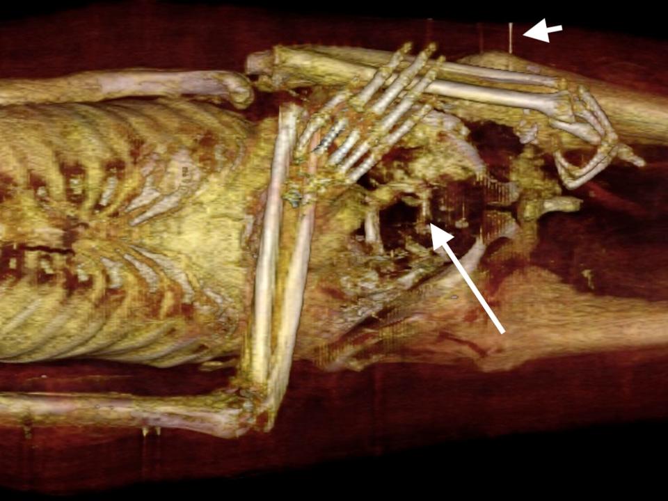 A front view of Amenhotep reveals post mortem breaks in his arms and hands.