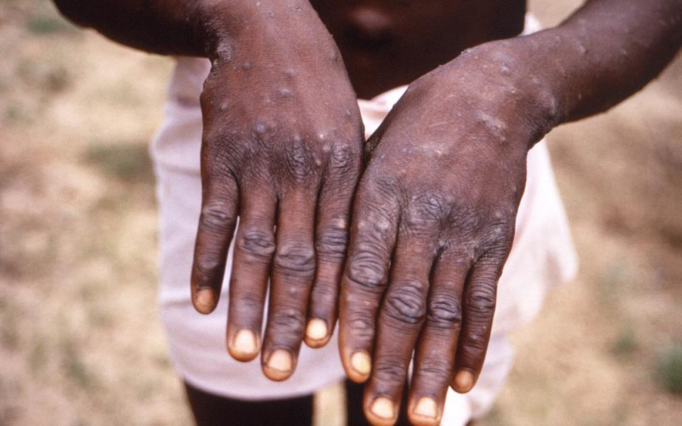  This photo was taken in 1997 during an investigation into an outbreak of monkeypox, which took place in the Democratic Republic of the Congo - BRIAN W.J. MAHY/ BRIAN W.J. MAHY