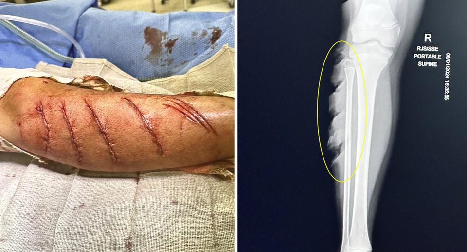 Left, Treyson's leg after surgery. Right, an x-ray of the deep gashes on his leg.