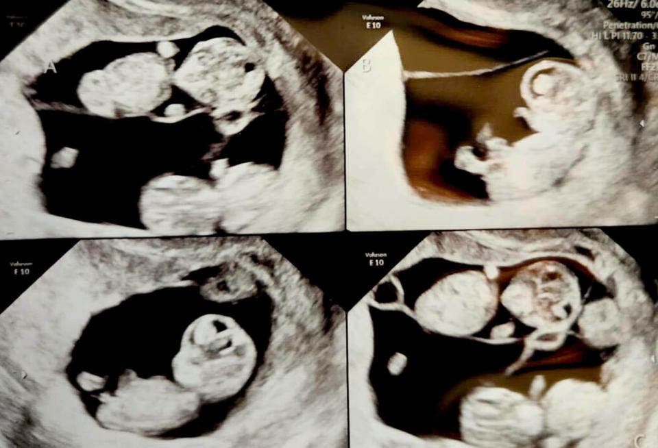 Couple welcomes identical quadruplet daughters (Courtesy Mercedes and Jonathan Sandhu)