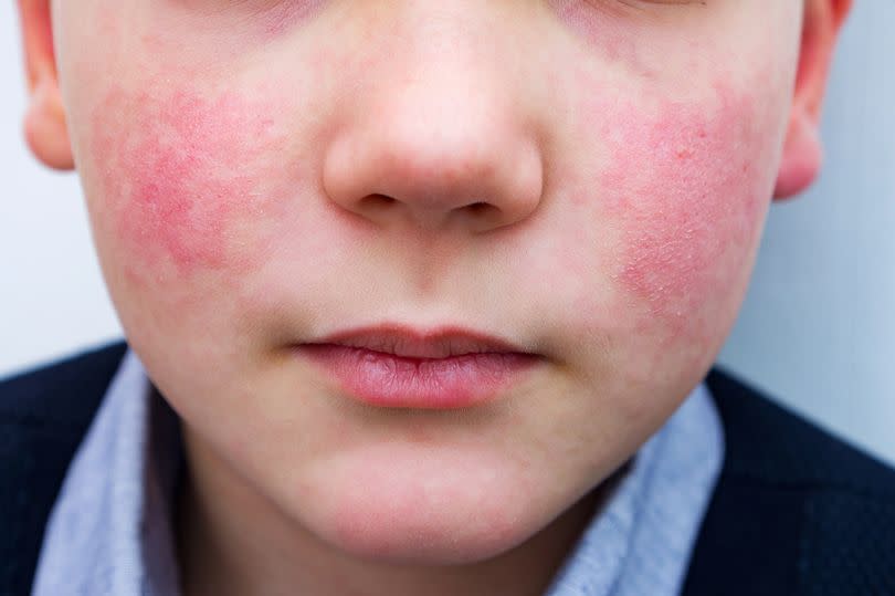 8 years old child with rosy cheeks