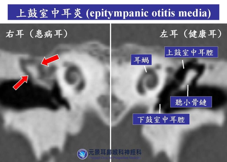 電腦斷層顯示右側中耳腔之上鼓室內有黏液（紅箭頭處），包圍住聽小骨鏈，此為上鼓室中耳炎。（醫師陳建志提供）