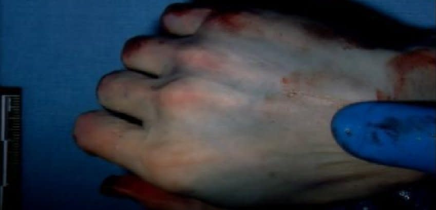 The prosecution contends this photo, shown in court on Jan. 8, 2013, shows Travis Alexander had multiple self-defense wounds to his palms and fingers that indicate he had fought for his life during the knife attack.