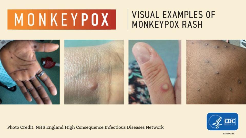 What monkeypox rashes can look like.