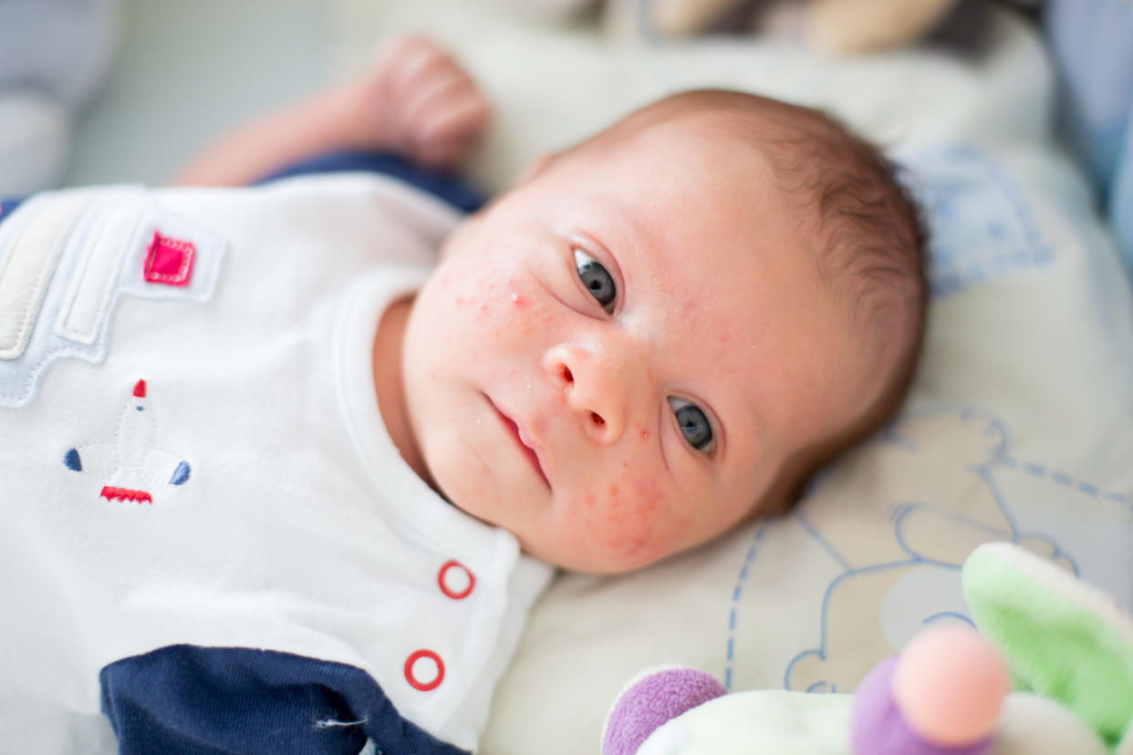 A baby boy lays on his back with his head turned towards the camera, with small red dots of inflammation on his cheeks and forehead