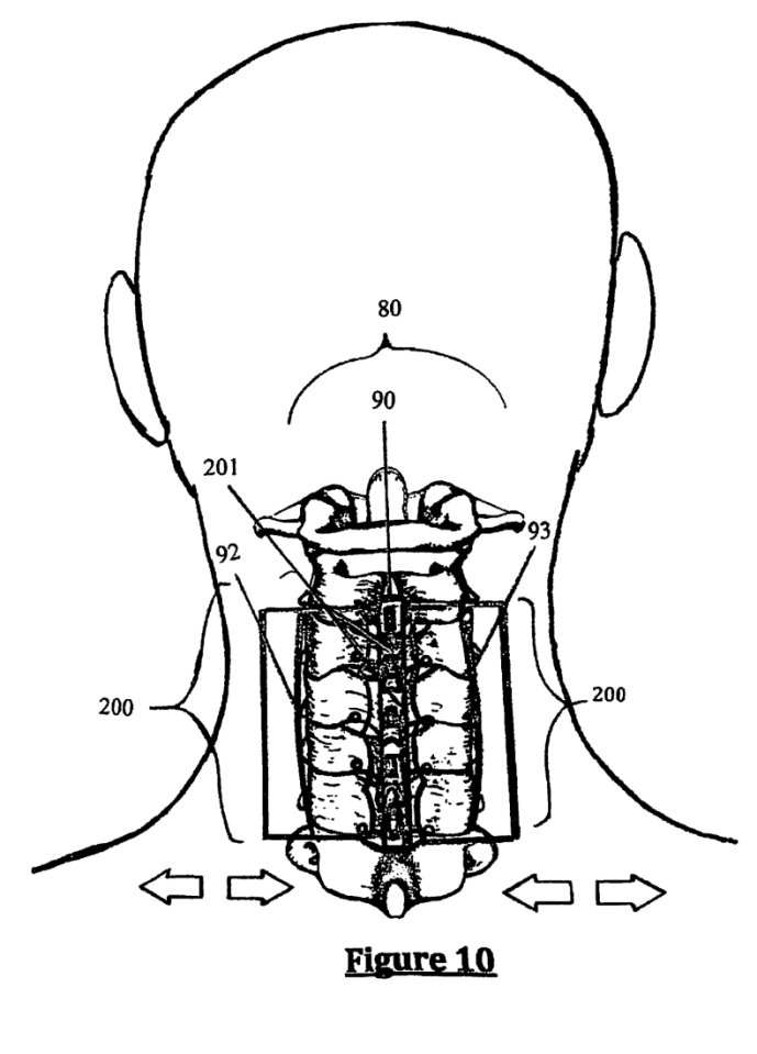 Image taken from the Cervi-Lok patent filing