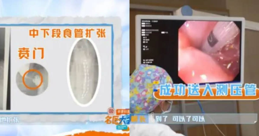 一名男子因罹患「賁門失弛緩症」，導致他的食道無法正常蠕動，每次進食只能吞下一粒米。（圖／翻攝自紅星新聞）