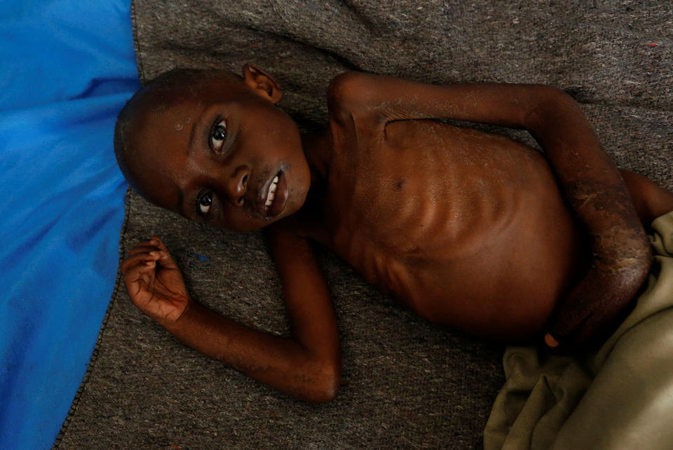 <p>Dieudonne Sabwa, 4, an internally displaced and severely acute malnourished child waits to receive medical attention at the Tshiamala general referral hospital of Mwene Ditu in Kasai Oriental Province in the Democratic Republic of Congo, March 15, 2018. (Photo: Thomas Mukoya/Reuters) </p>