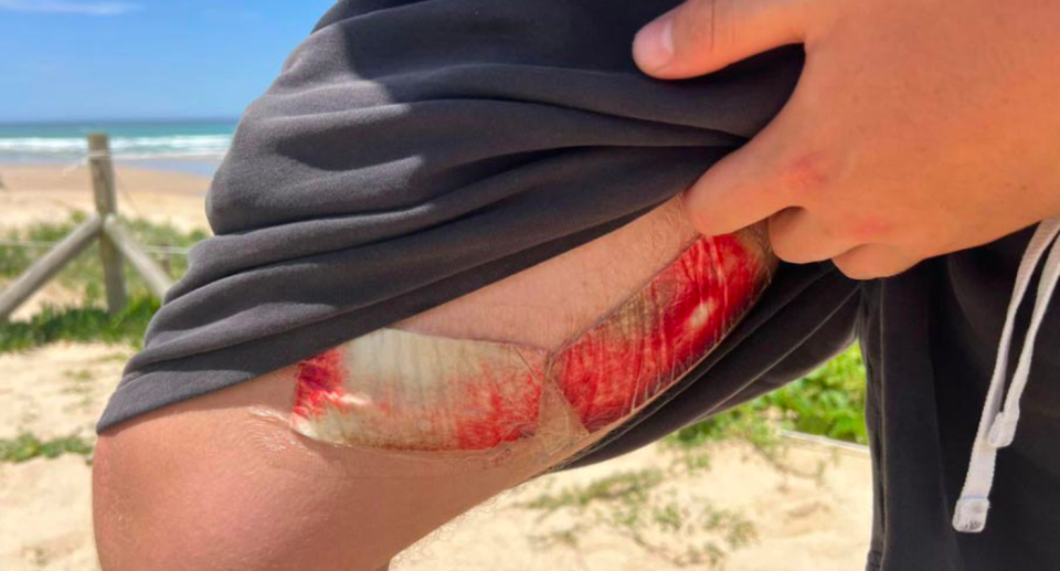 Image of Alex's shark bite on his thigh covered in gauze. 