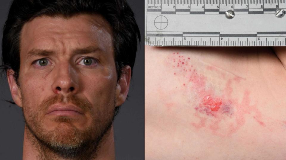 Gareth Pursehouse appeared to have a black eye and a bite mark on his bicep. / Credit: Superior Court of California, County of Los Angeles