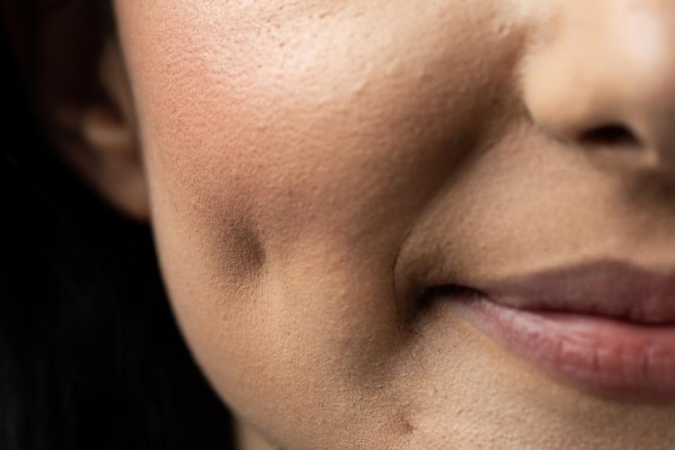 Dimples have been long associated with youthful faces. ShutterDivision – stock.adobe.com