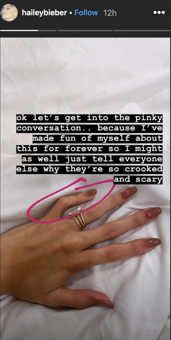 Model addressed her crooked fingers on Instagram (Instagram)