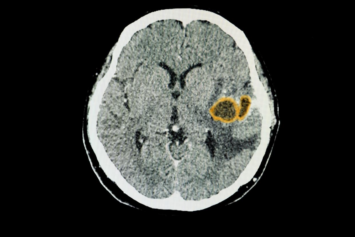 A CT brain scan of a patient with large brain abscesses.