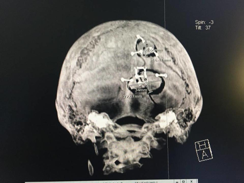 An x-ray shows titanium screws in Jack Fink’s skull after sustaining an injury when a deer collided with the Aledo freshman during a cross country practice.