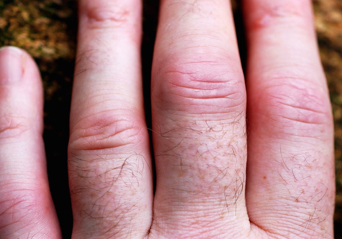 rheumatoid arthritis