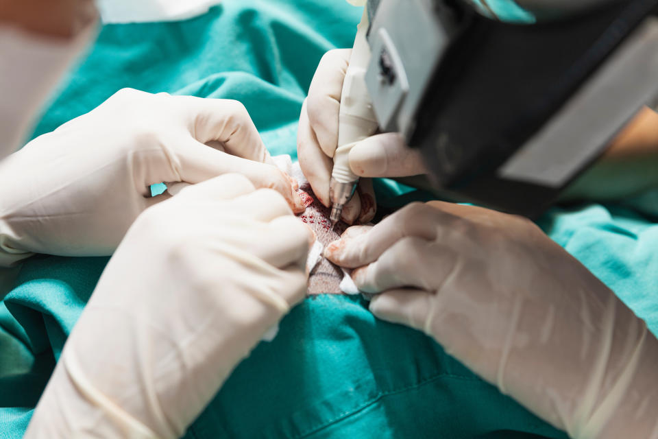 a team of hair transplant clinicians using a tool to plant hair follicles