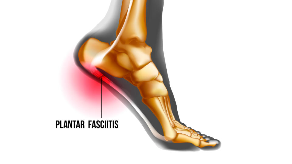 An illustration of plantar fasciitis