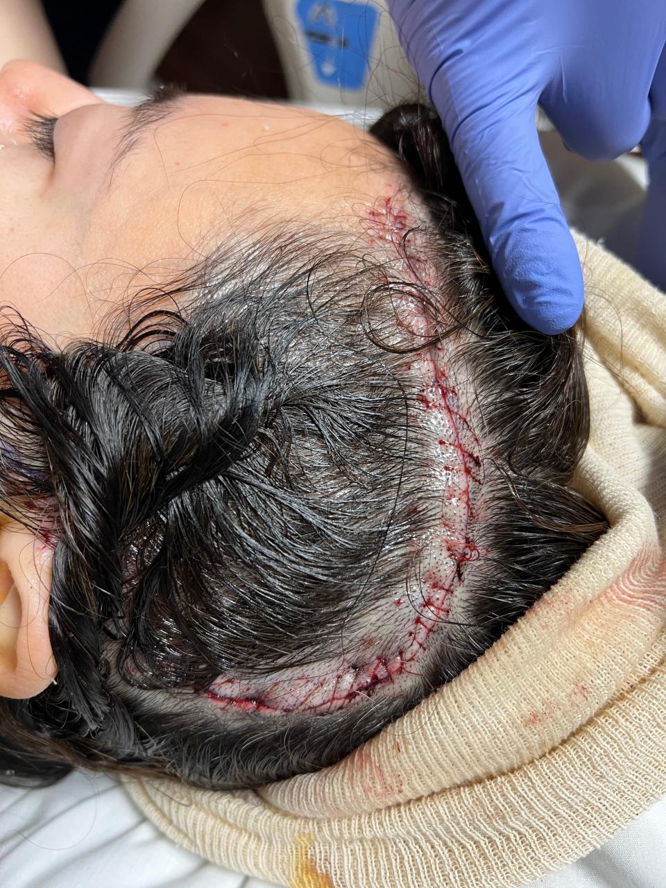 Lucy Garcia's scar from her brain tumor removal was bigger than she expected, but now, she says, her hair covers it nicely.