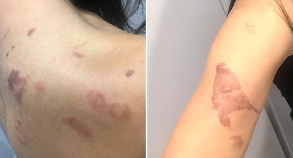 Burns on Giovanna's back and upper arm after Aldi cooker exploded.