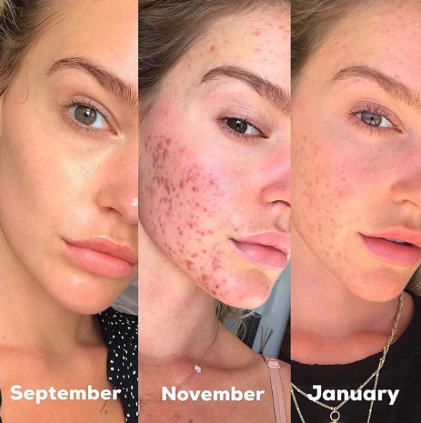 The model has found a new level of fame after being open with fans about her tough battle with adult acne as a result of auto immune medication. Photo: Georgia Gibbs/Instagram