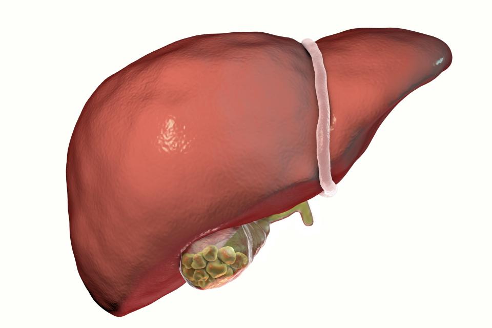 Gallstones