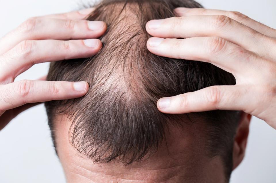 A new study sheds promising light on preventing hair loss. vfhnb12 – stock.adobe.com