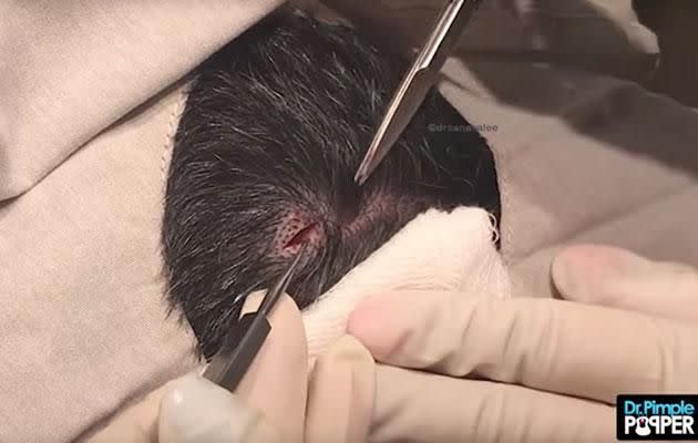 The video starts off with Dr Lee making an incision into the man's head. Photo: Youtube/Dr Sandra Lee