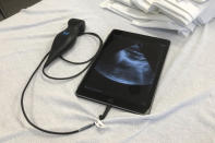 This Aug. 2, 2019 photo shows a Butterfly iQ handheld ultrasound device attached to a tablet on a bed at the Indiana University medical school in Indianapolis. The device shows instant images of the heart and other organs, helping doctors diagnose a range of ailments. (AP Photo/Lindsey Tanner)