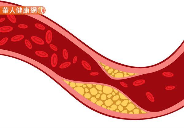 如果患者有高血脂問題卻未加以積極改善，長期下來恐將造成血管硬化、阻塞發生，使未來罹患心血管疾病、腦中風的風險大幅提升，其嚴重性不容小覷！