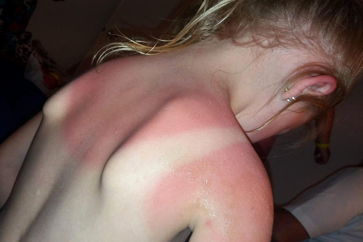 Her daughters were left sunburnt even though they’d worn Factor 50 all day [Photo: Caters]