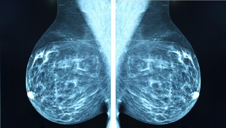 What Causes Breast Cancer? The 18 Factors That Put You at the Biggest Risk