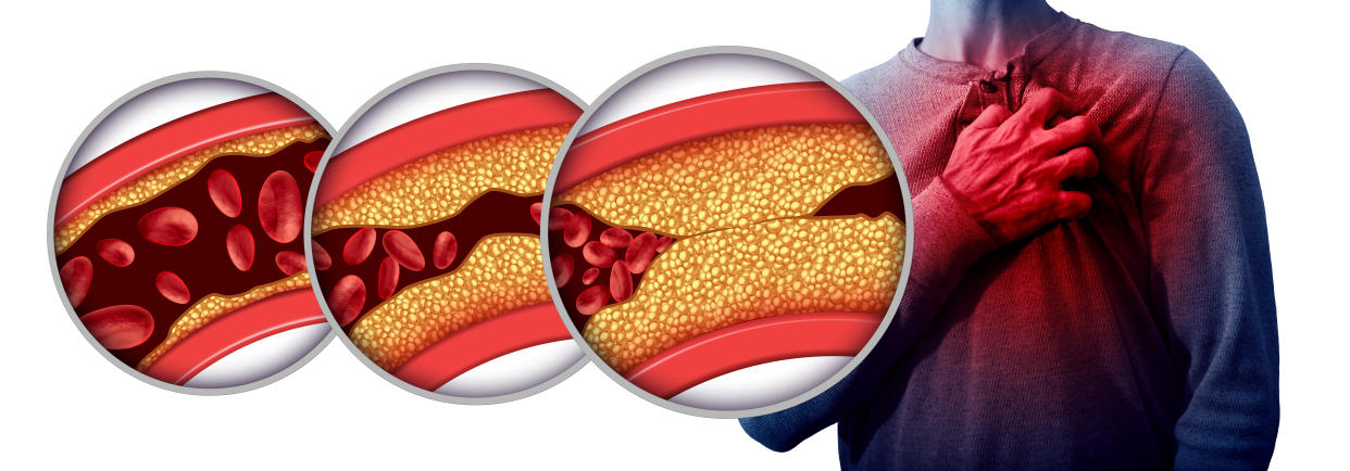 Tener unos niveles no controlados de colesterol LDL en sangre puede contribuir a desarrollar hasta el 60 por ciento de los infartos o anginas de pecho y el 40 por ciento de los ictus. (Foto: Getty)