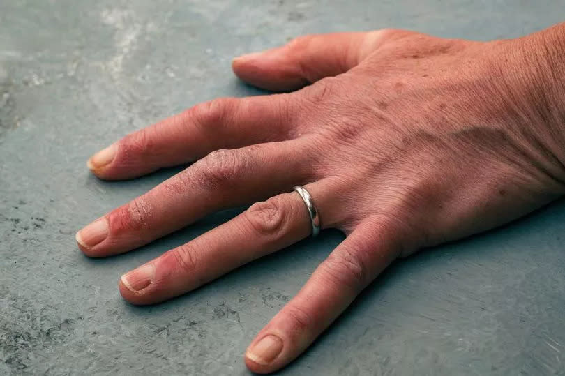 Close up of a mature woman with chilblains to her fingers.