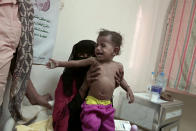 <p>Umm Molham, a Yemeni mother who is herself undernourished, struggles to hold up her malnourished 13-month-old son Molham at the Ibn Kholdoon Hospital, in Lahj, Yemen, in this Feb. 11, 2018 photo. The toddler had been vomiting, coughing and suffered from diarrhea. The family can only afford to give him formula once a day. (Photo: Nariman El-Mofty/AP) </p>