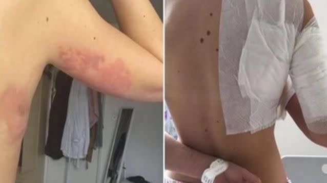 The burns the girls suffered in the attack. Photo: 7 News