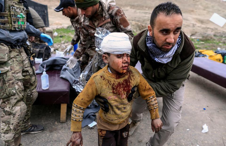 A boy injured in a mortar attack walks toward an ambulance after being treated by medics in a field clinic as Iraqi forces battle with Islamic State militants, in western Mosul, Iraq March 2, 2017.